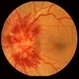 Optic Disc Edema and Hemorrhages with Subdural Hematoma Optic Disc Edema and Hemorrhages with Subdural Hematoma